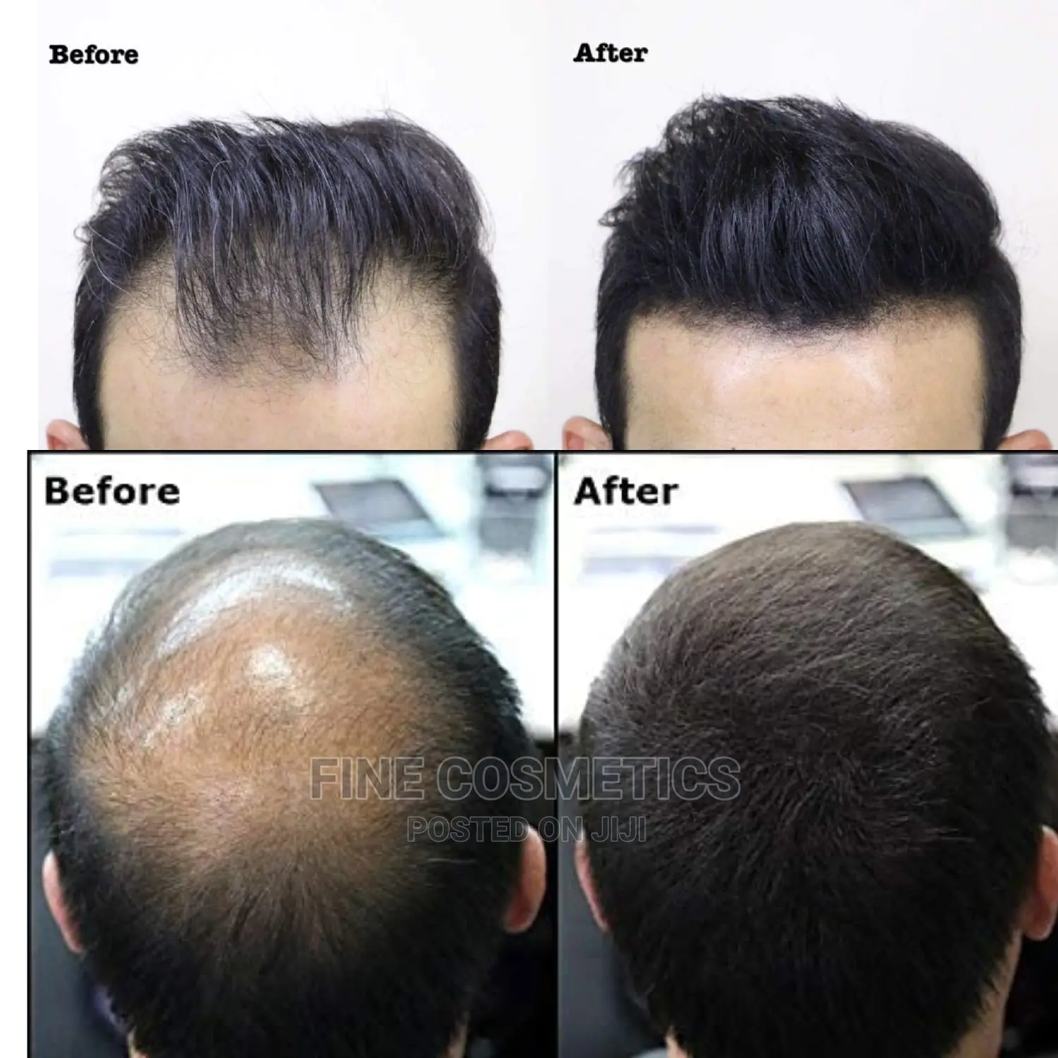 Thick Fiber Hair Building Kit for Bald Head and Thining Hair