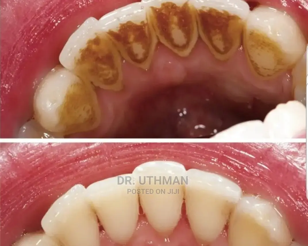 Teeth Scalling and Polishing