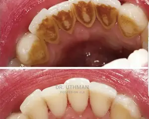 Teeth Scalling and Polishing