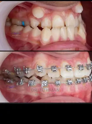 Teeth Allighnements