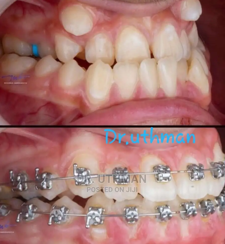 Teeth Allighnements