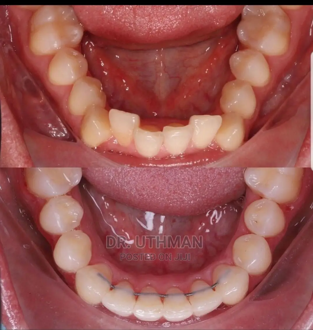 Teeth Allighnements