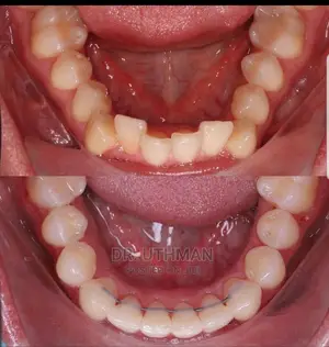 Teeth Allighnements