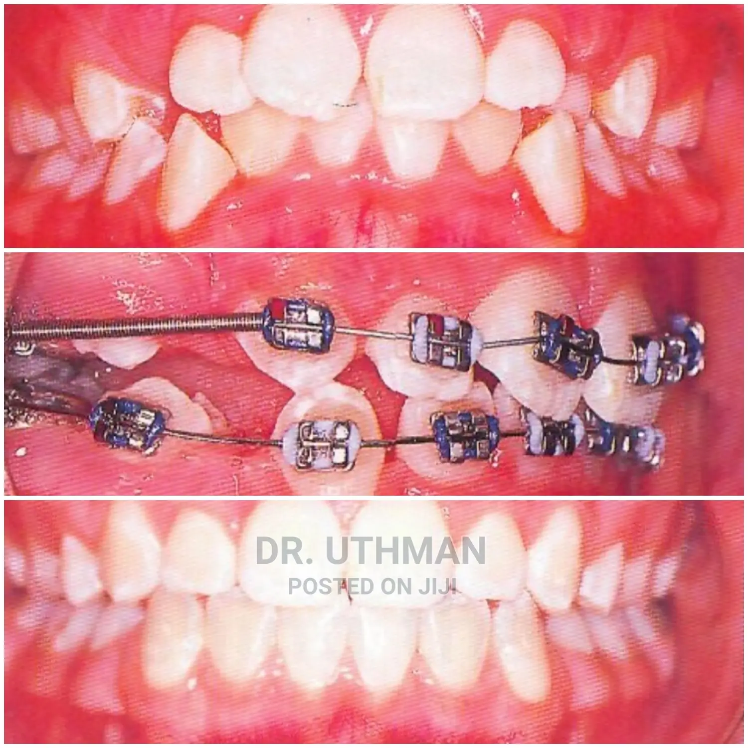 Teeth Allighnements