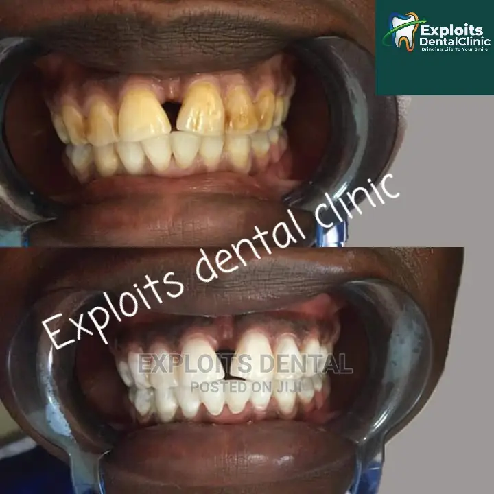Teeth Whitening
