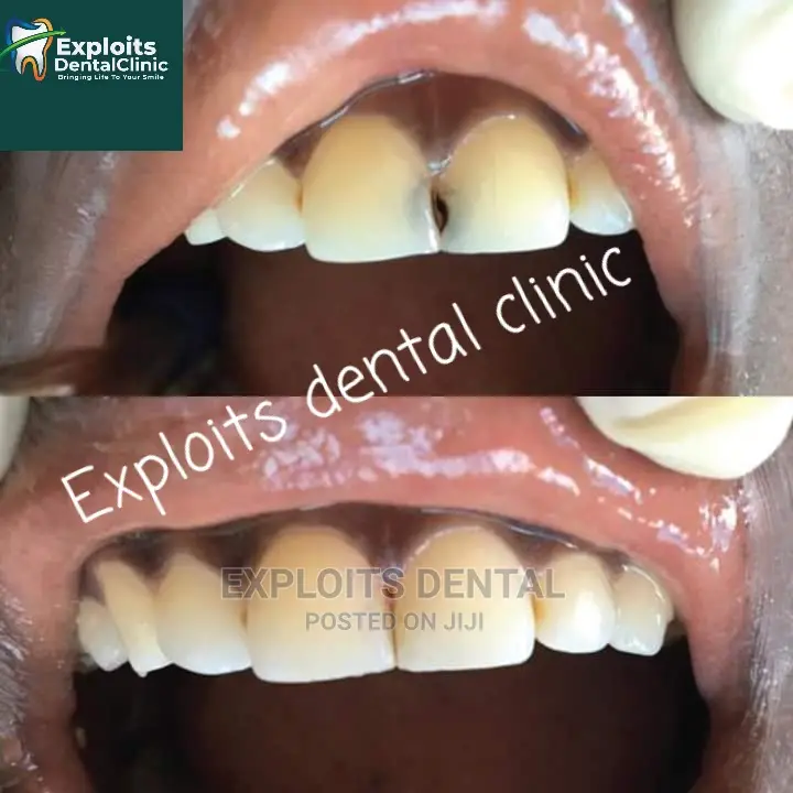 Composite Filling and Crowns