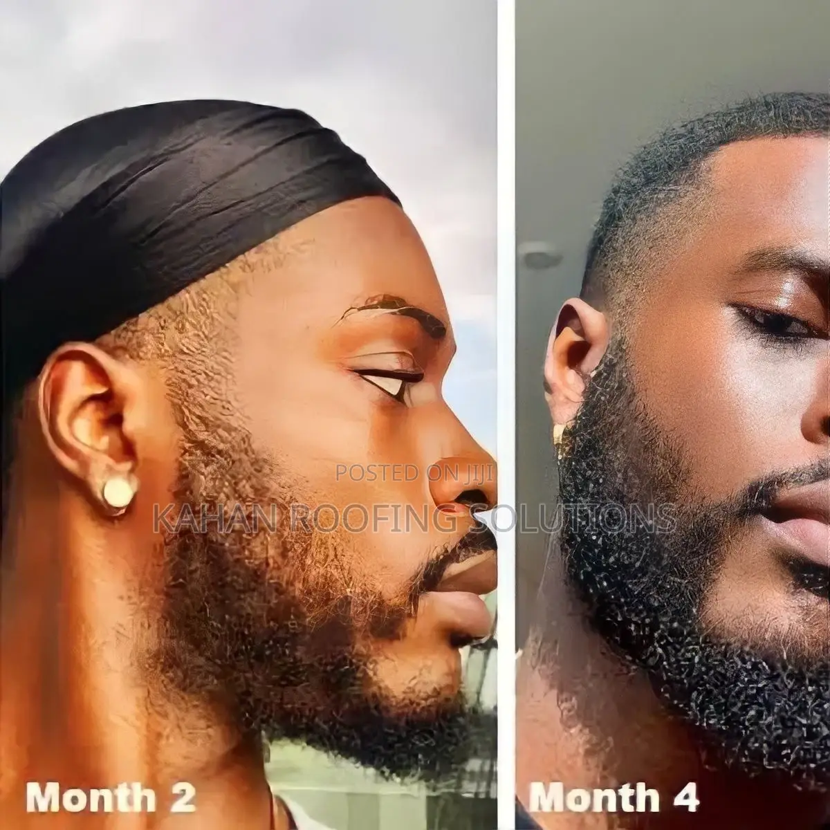 Minoxidil 5% Kirkland Solution