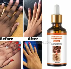 Black Fingers Dark Knees Dark Knuckle Remover
