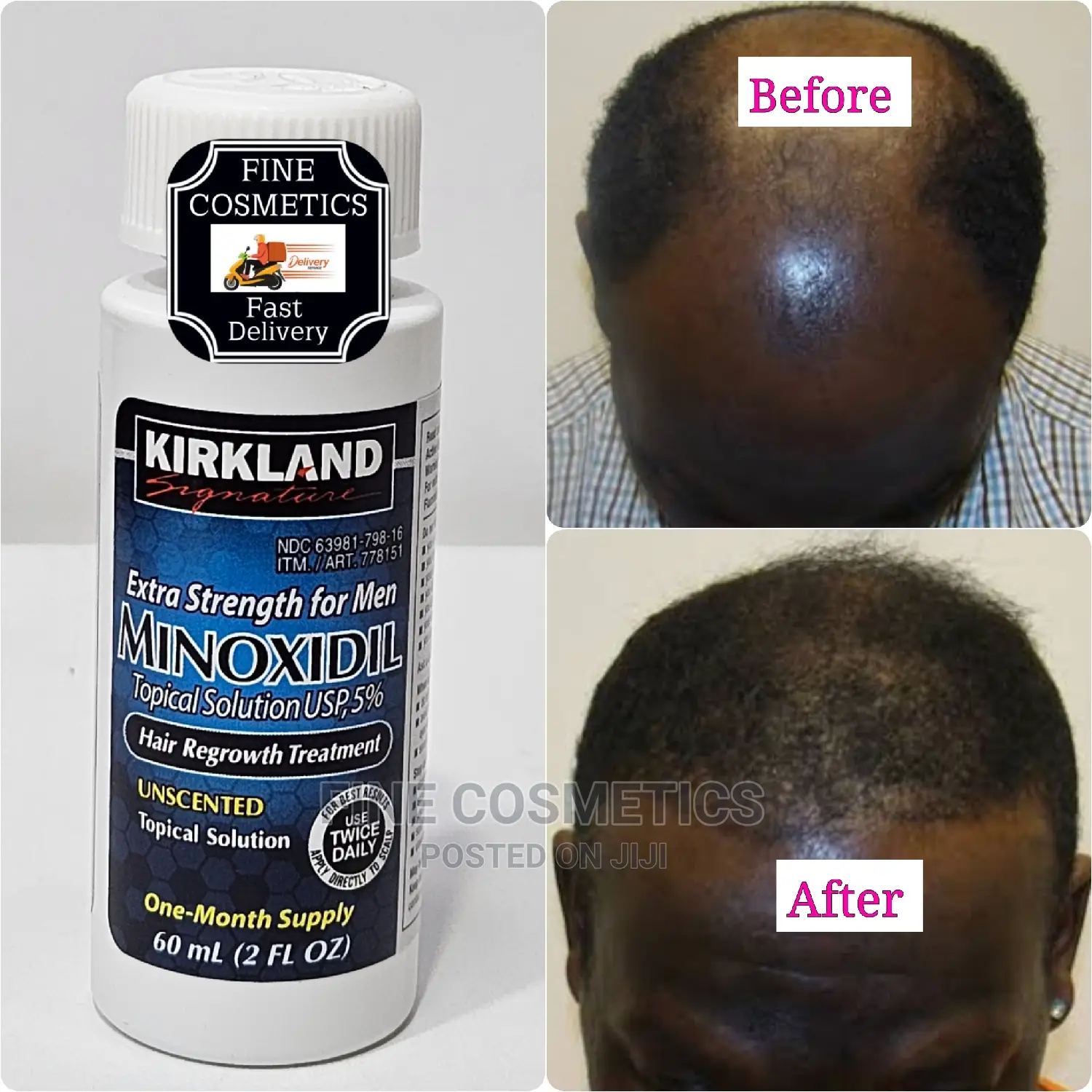 Minoxidil 5% Extra Strength Hair Regrowth Treatment for Men