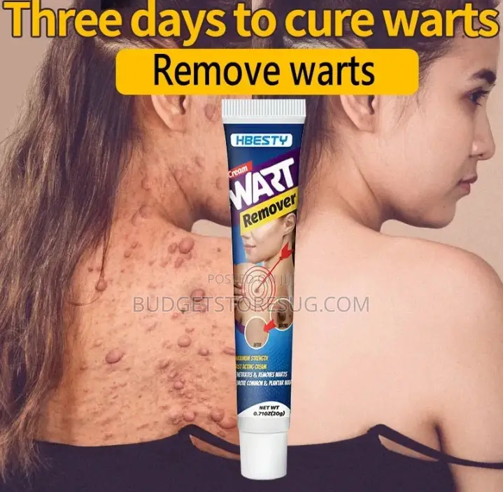 Painless Wart Remover