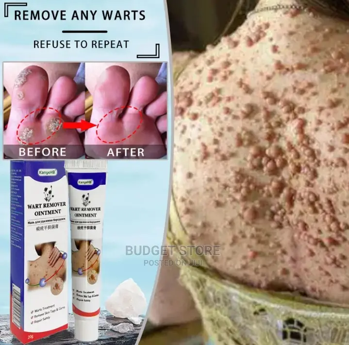 Remove Any Wart
