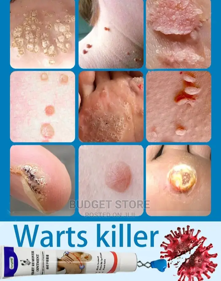 Remove Any Wart