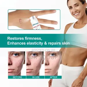 Skin Care Scar Removal Spray Acne Repair
