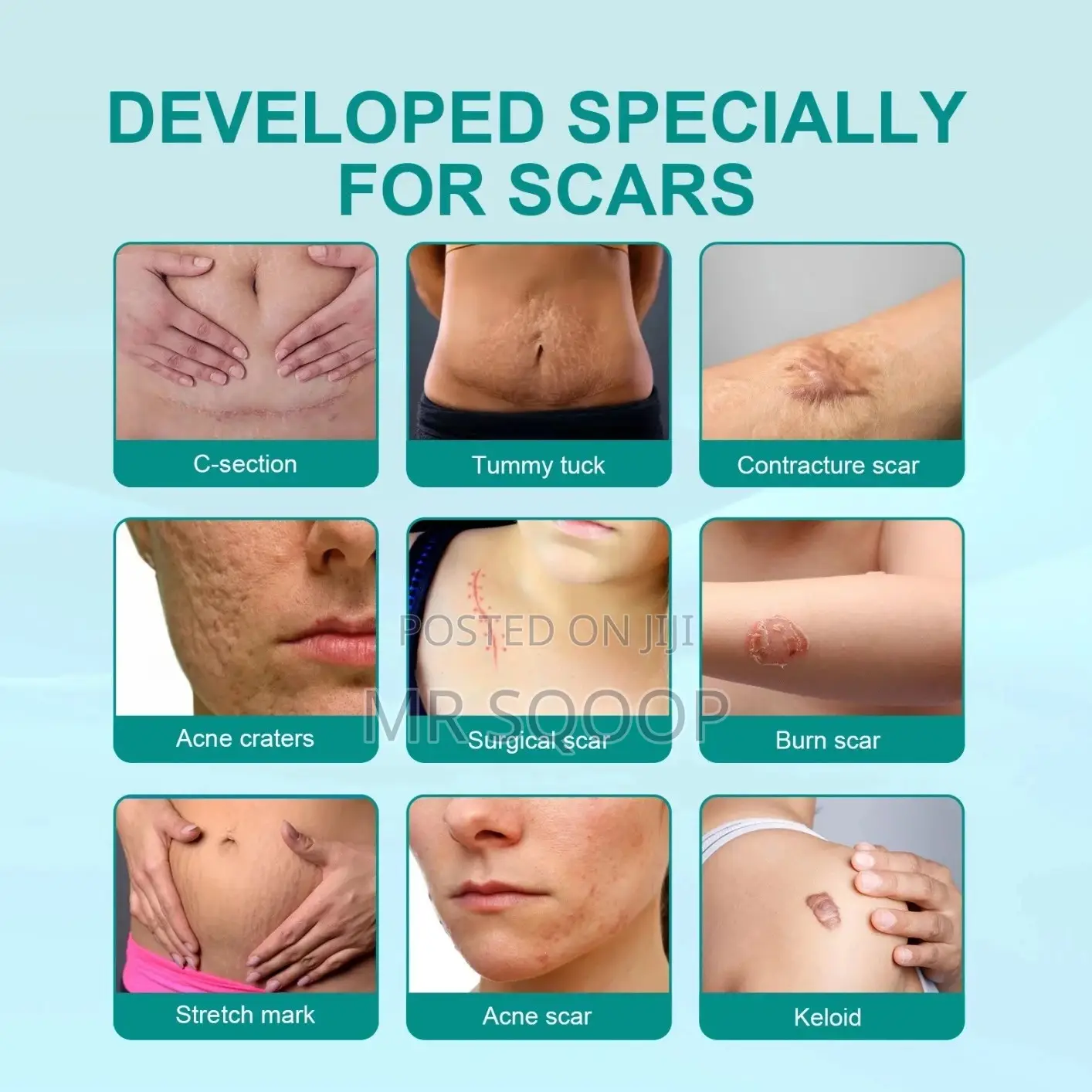 Skin Care Scar Removal Spray Acne Repair