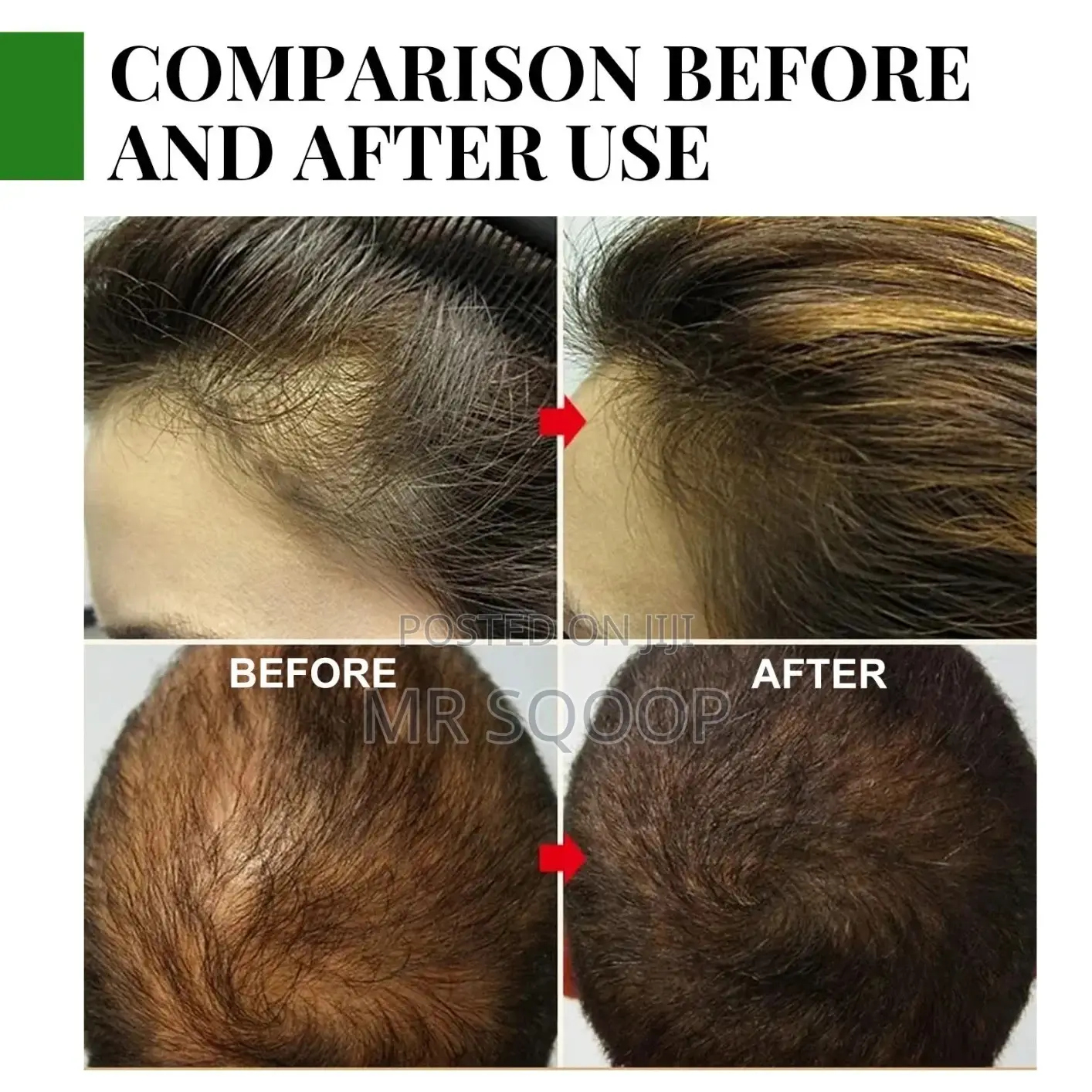 Rosemary Essential Oil for Hair Growth Scalp Care – 30ml