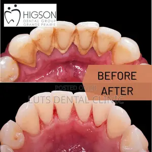 Professional Teeth Cleaning