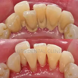 Professional Teeth Cleaning