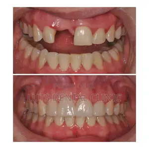 Fixing Missing Teeth