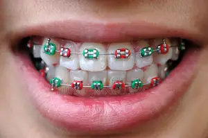 Dental Braces