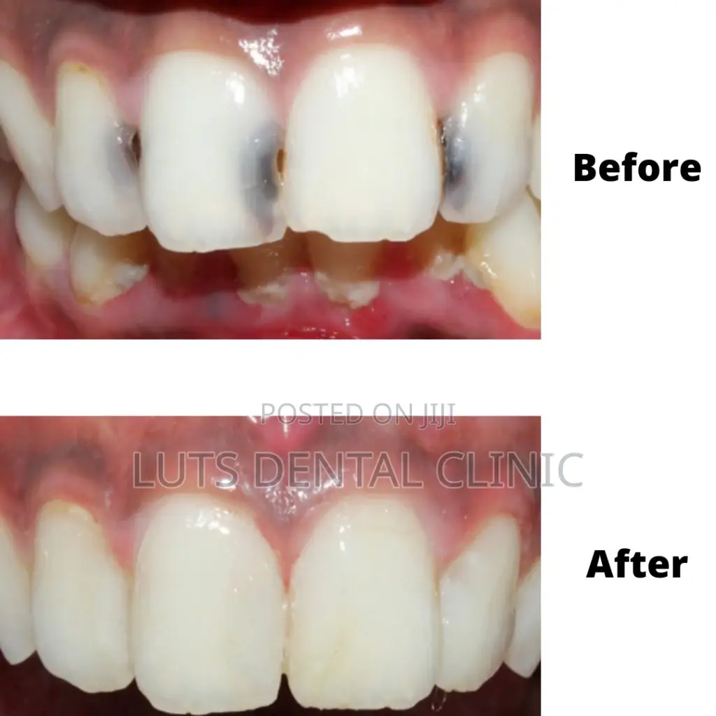We Repair Decayed Teeth to Normal Colourand Shape
