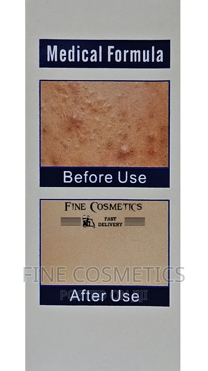 Medical Formula Anti-Acne Pimple Fight Whitening Face Serum