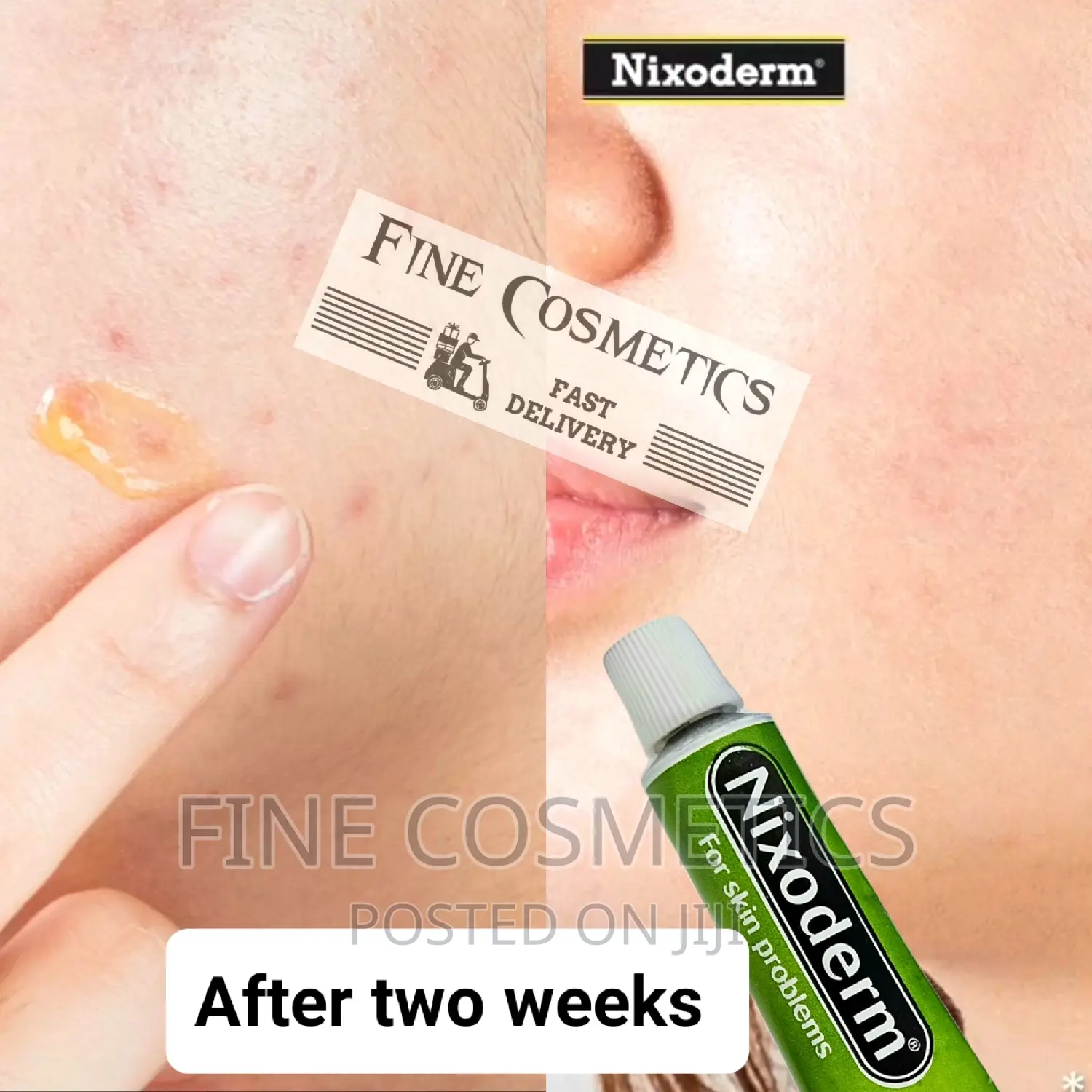 Original NIXODERM Ointment for Skin Problems: Eczema, Pimple