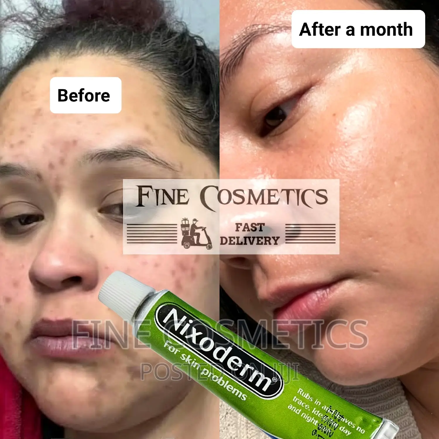 Original NIXODERM Ointment for Skin Problems: Eczema, Pimple