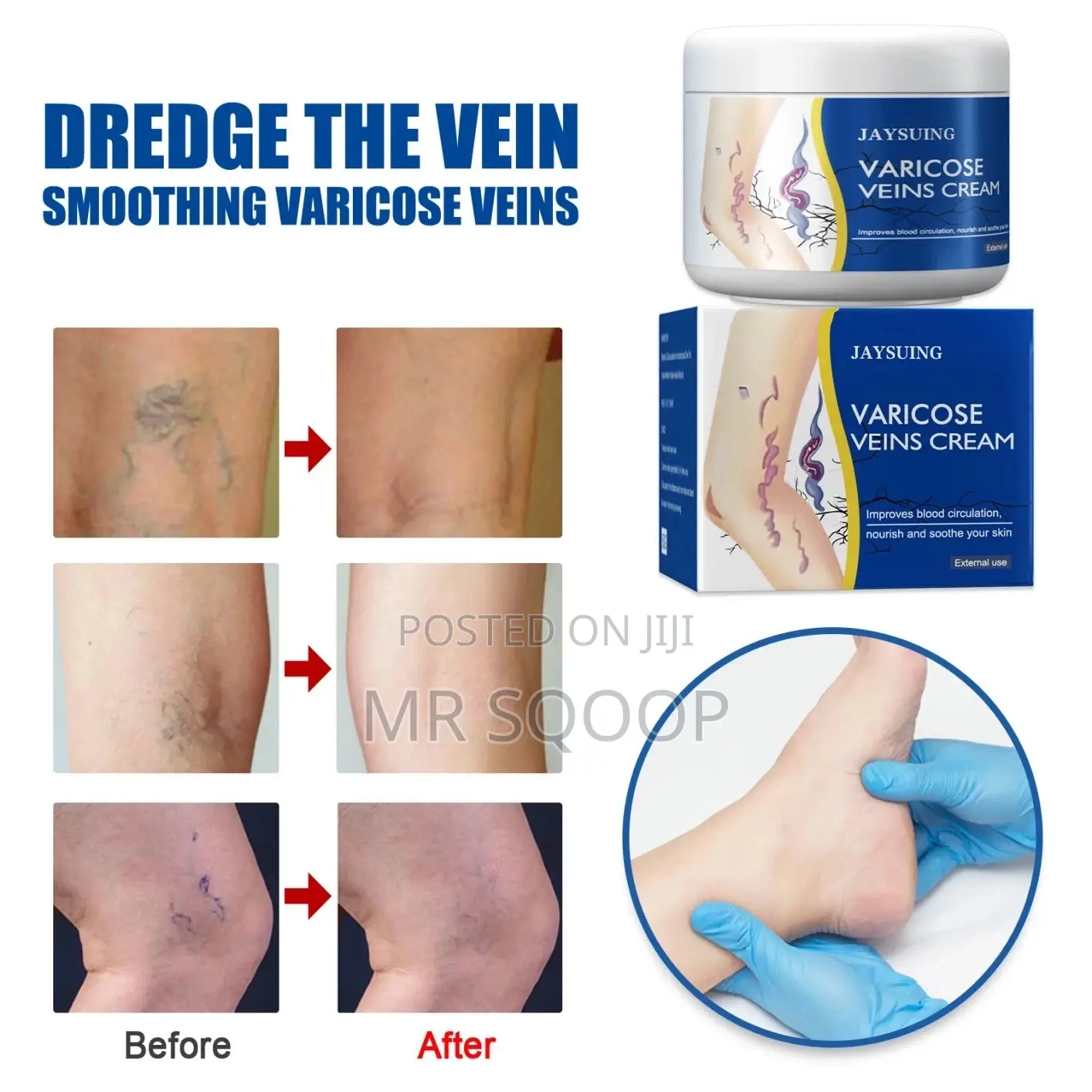 Varicose Veins Cream For Leg Pain Swelling 50g