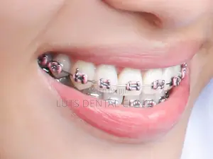 Braces to Correct Malalligned Teeth and Bites
