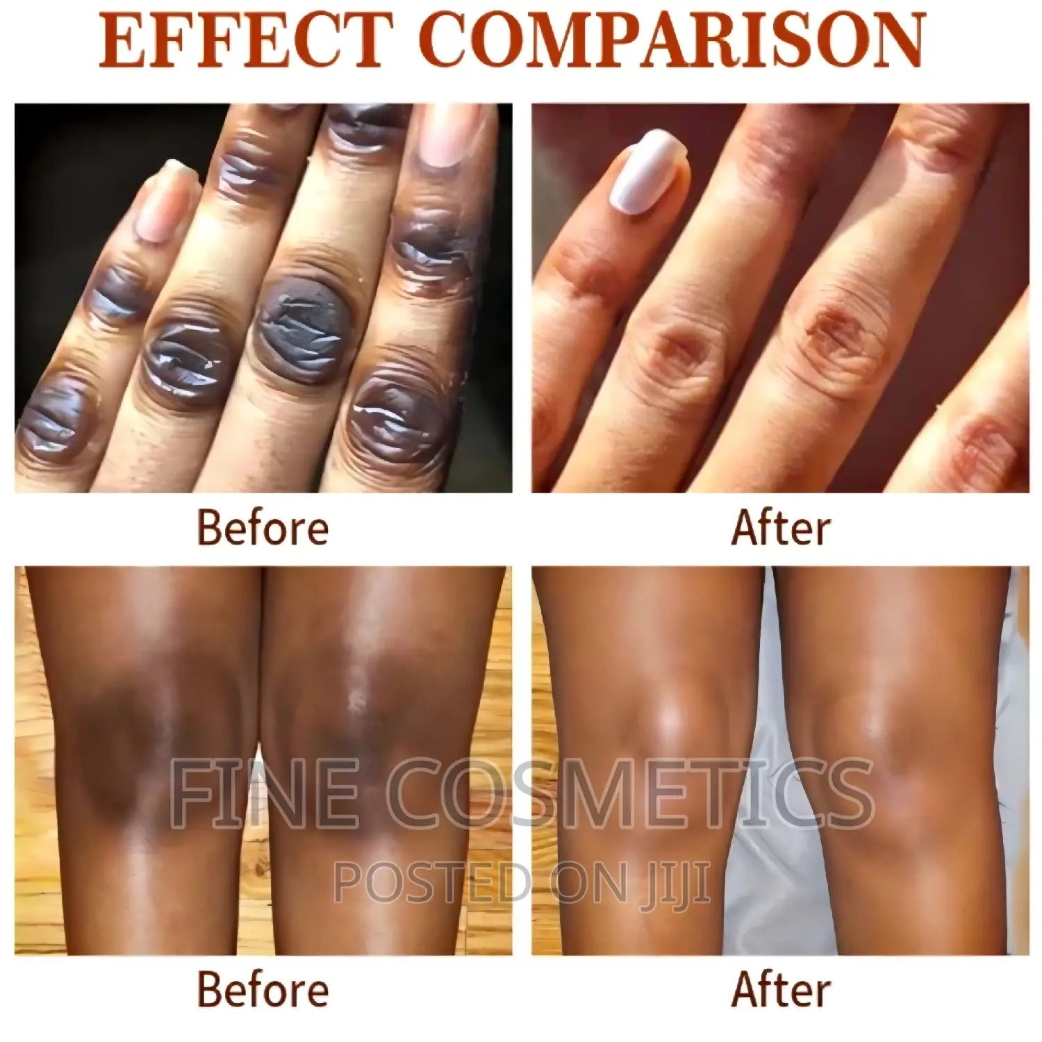 Spot Off |Dark Knuckle Remover Cream Care for Feet and Knees