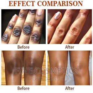 Spot Off |Dark Knuckle Remover Cream Care for Feet and Knees