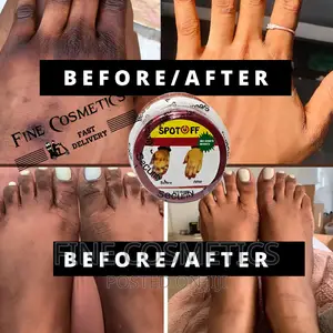 Spot Off |Dark Knuckle Remover Cream Care for Feet and Knees