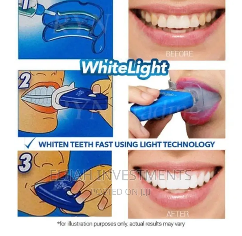 White Light Professional Teeth Whitening Kit