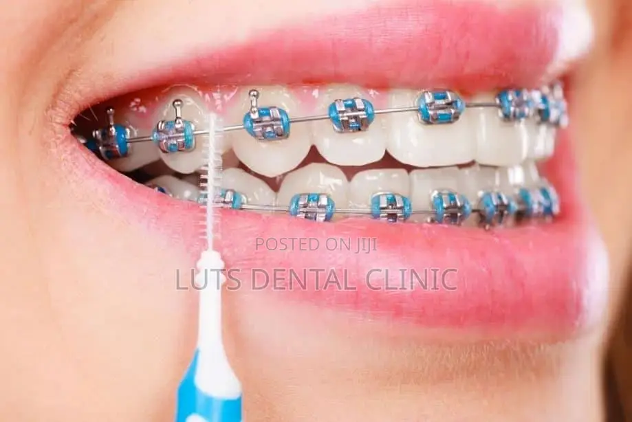 Teeth Braces
