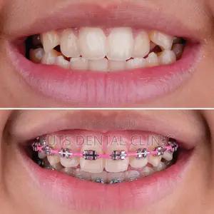 Teeth Braces