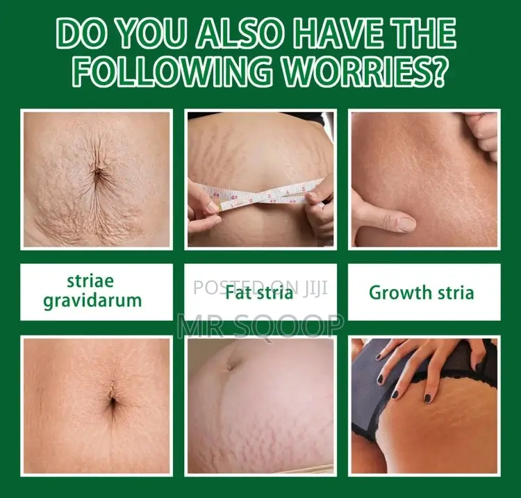 Jaysuing 7 Days Stretch Marks Removal Spray Postpartum
