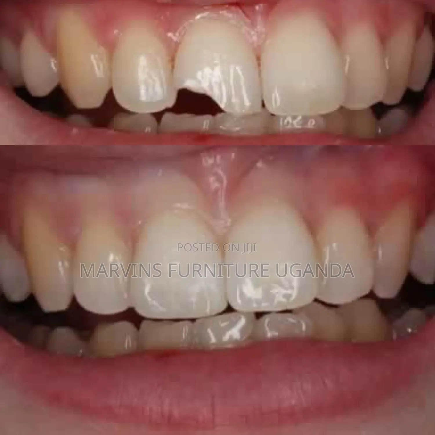 Broken ,Cracked or Chipped Teeth