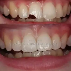 Broken ,Cracked or Chipped Teeth