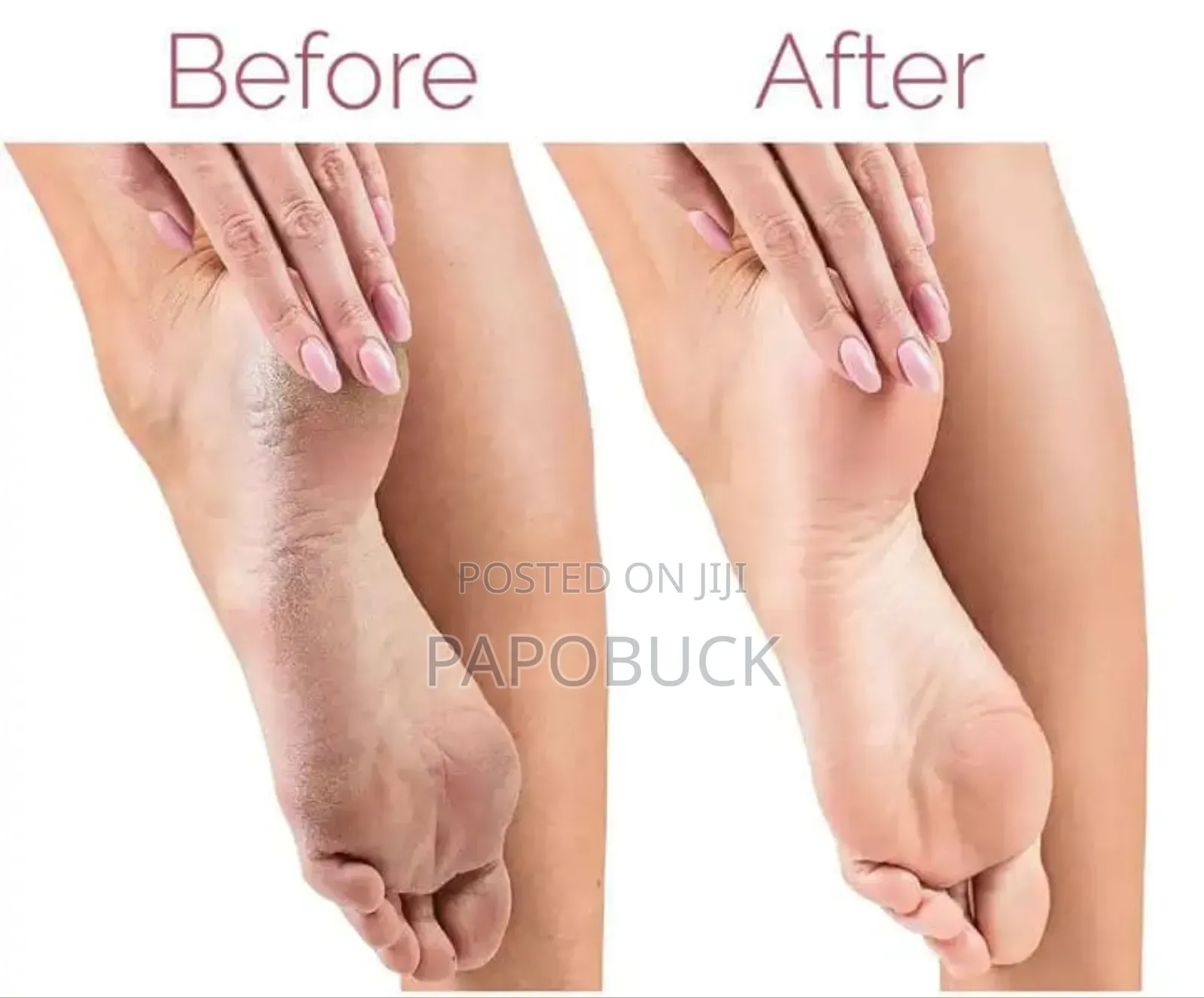 Electric Foot Callus Remover