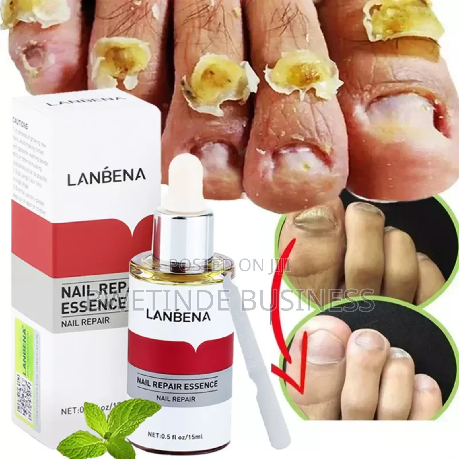 Lanbena Fungal Nail Treatment Repair