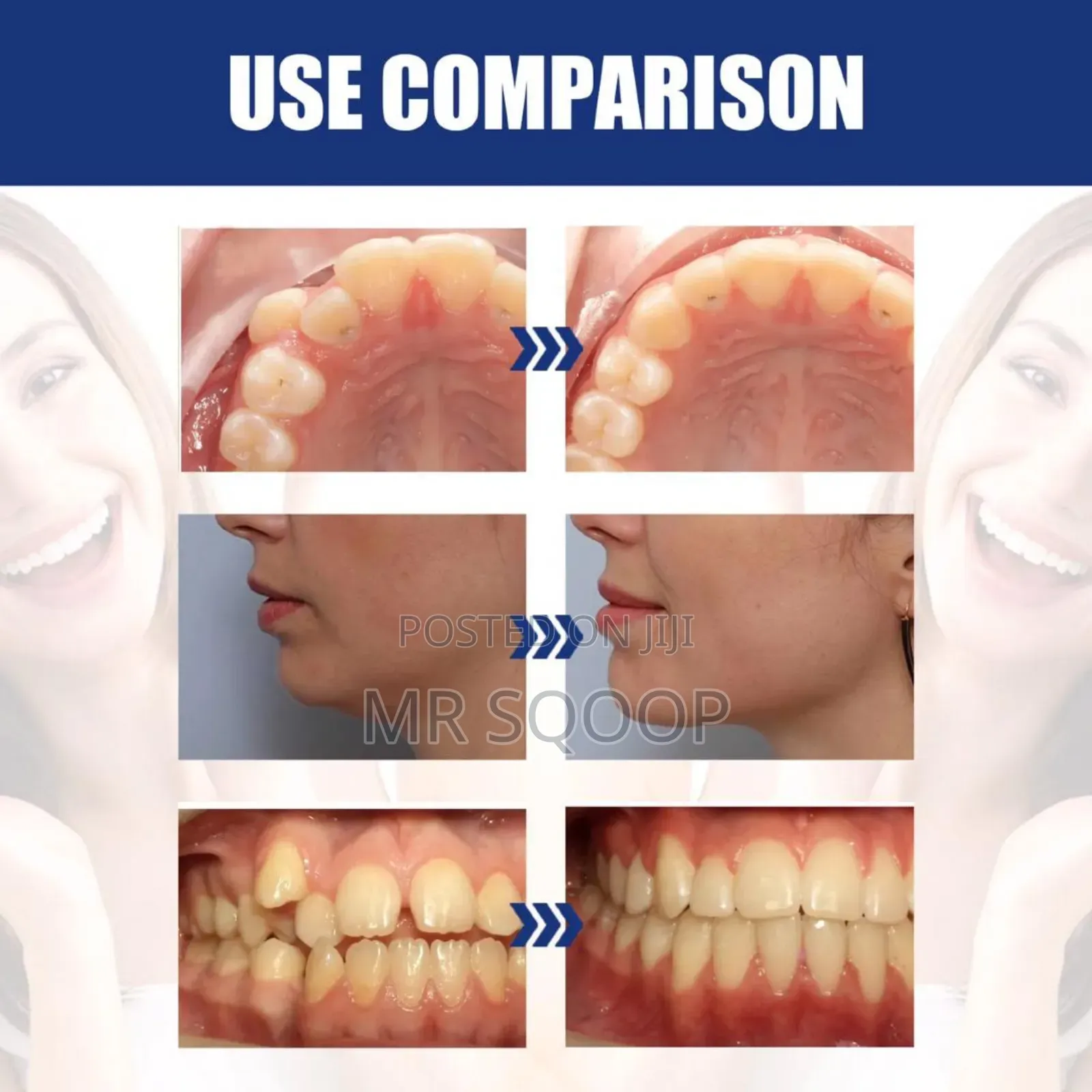 Jawbone Dental Alignment Brace Repair Teeth Deformity Stent