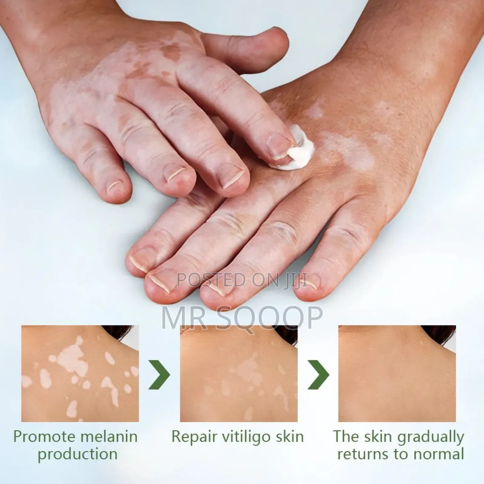 Vitiligo Care Relief Cream Skincare