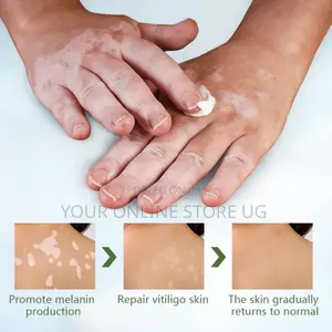 2pcs Sumifun Vitiligo Skin Care Cream for Daily Skincare