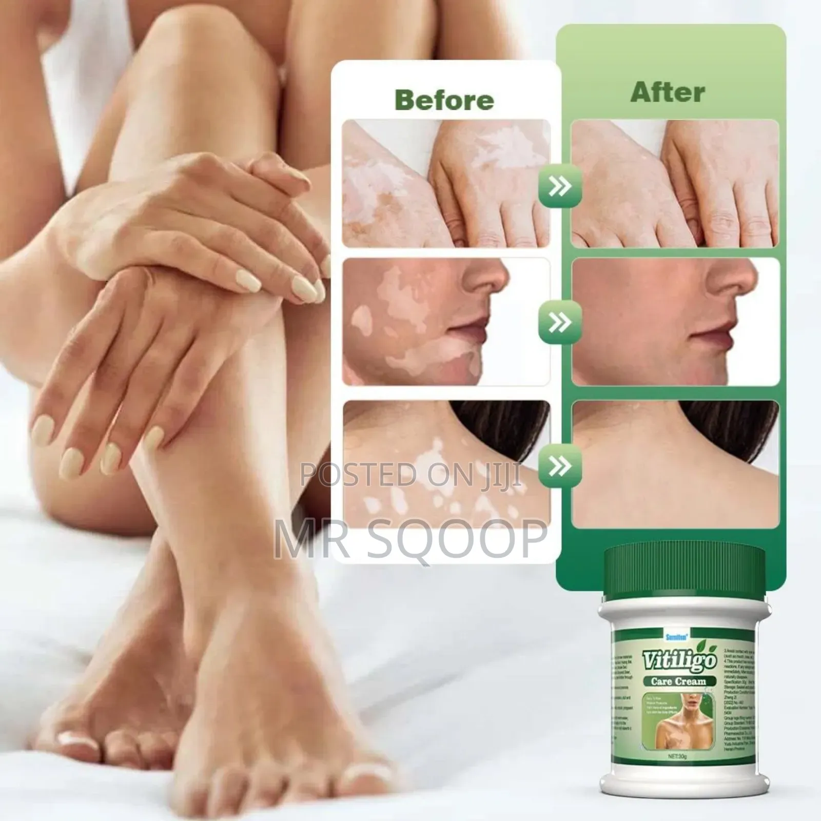 Vitiligo Care Relief Cream Skincare