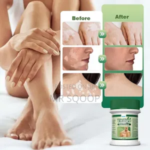 Vitiligo Care Relief Cream Skincare