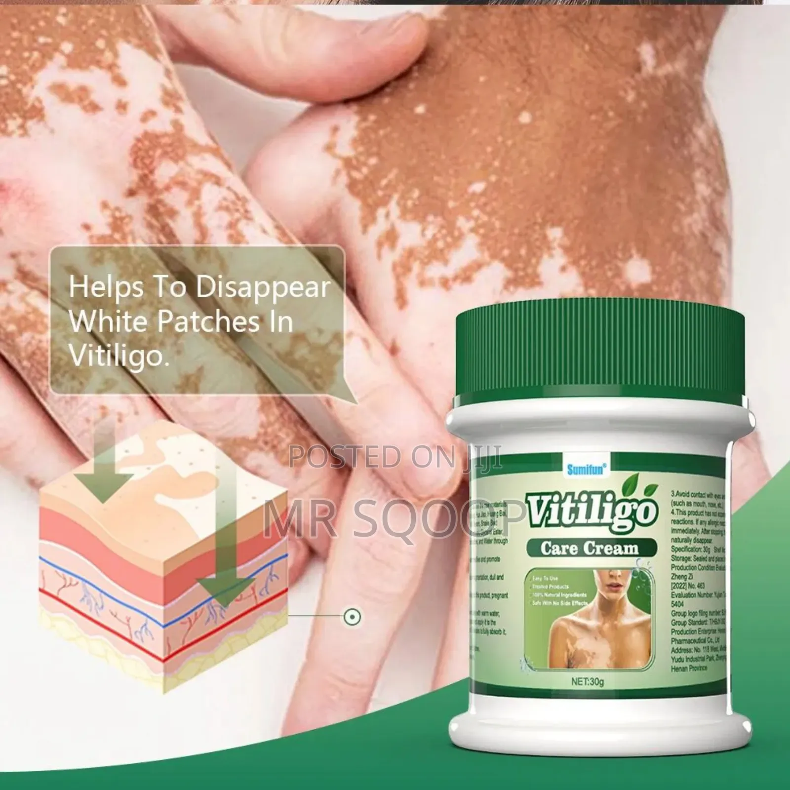 Vitiligo Care Relief Cream Skincare