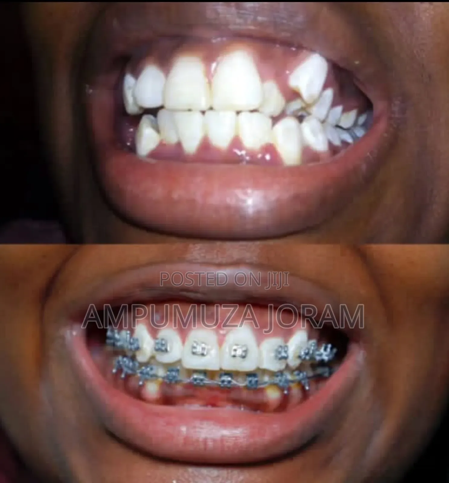 Orthodontic Braces
