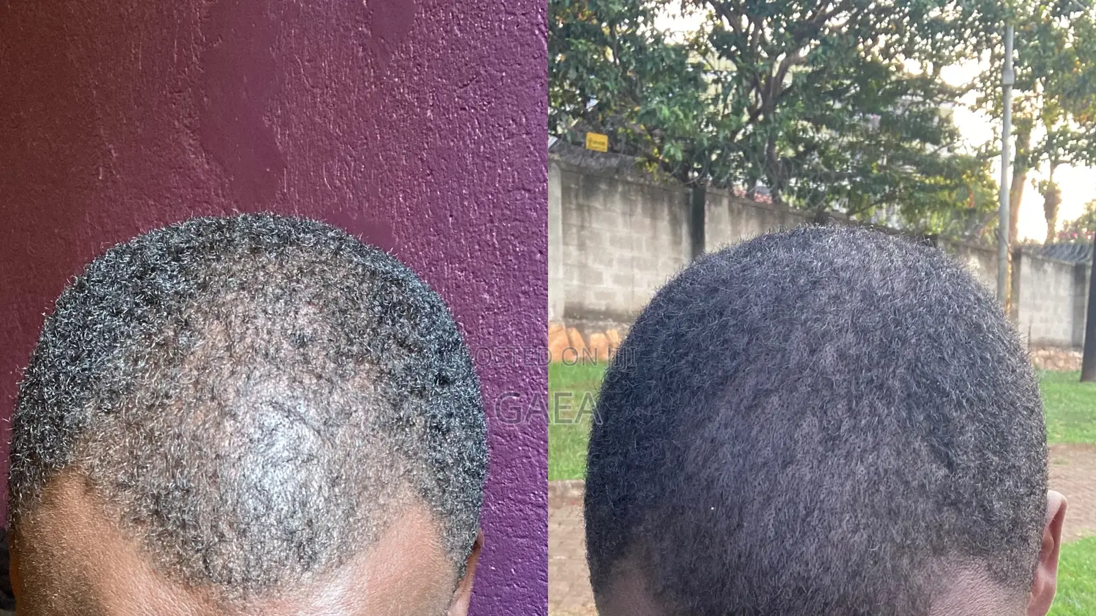 Minoxidil 5% - Kirkland Original