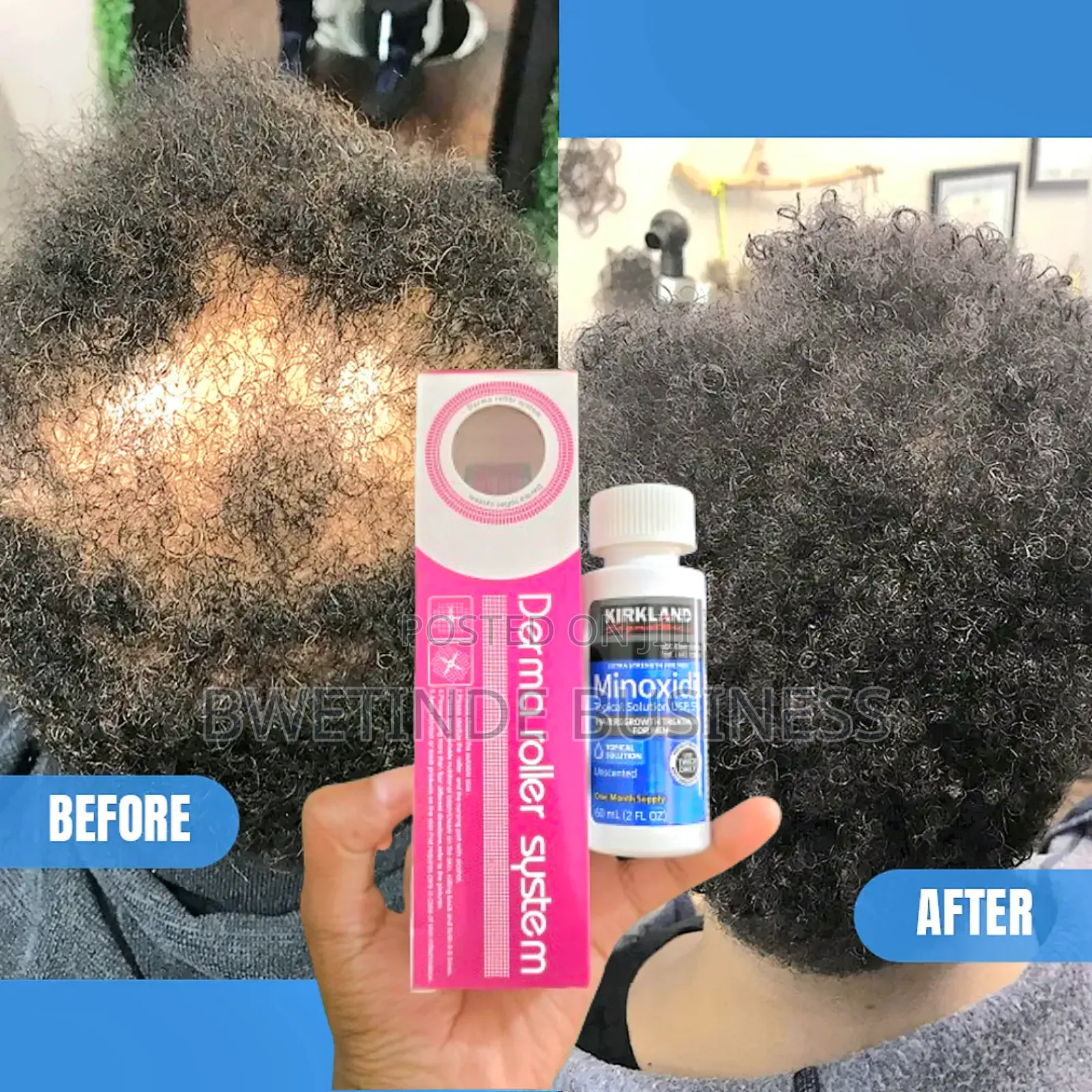 Hair /Beards Fast Growth Solution for Treating Baldness