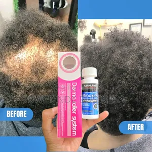 Hair /Beards Fast Growth Solution for Treating Baldness